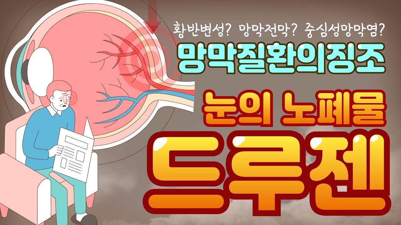 눈의 노폐물 드루젠 | 황반변성 | 망막질환 |  카이안과TV