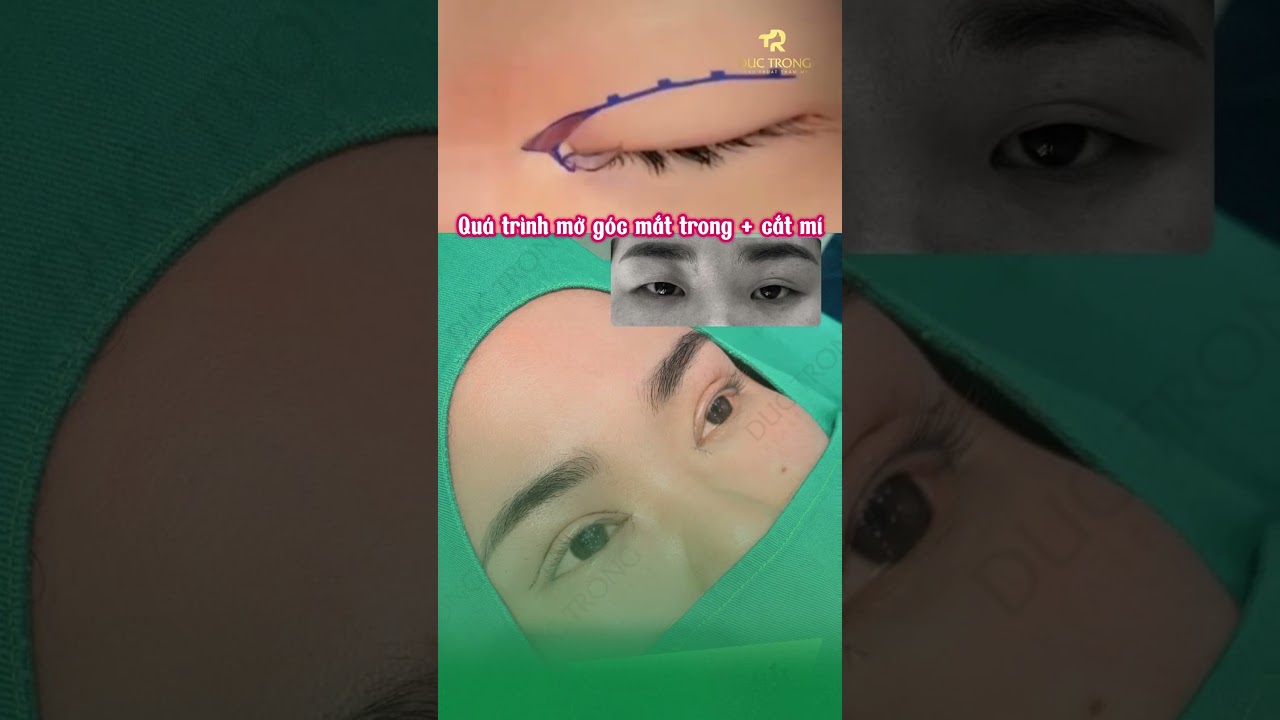 Qu&aacute; tr&igrave;nh mở g&oacute;c mắt trong + Cắt m&iacute;  | B&aacute;c sĩ Trọng #shots #bacsitrong #shotrs