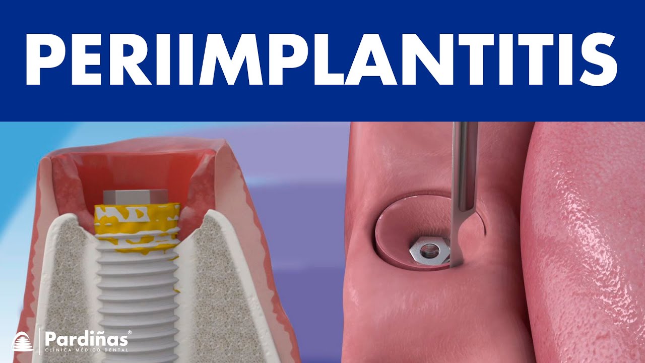 Periimplantitis - Probleme mit Zahnimplantat ©