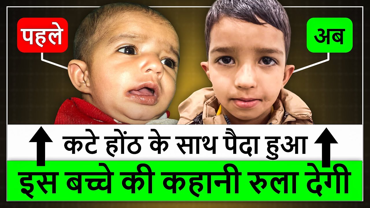 100% निशुल्क कटे होंठ और तालु की सर्जरी, Best Cleft Lip Hospital in India, by Dr Satya Saraswat