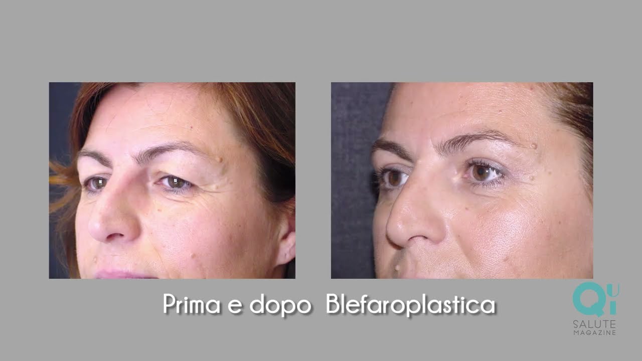 Chirurgia dello sguardo: blefaroplastica con lifting del sopracciglio