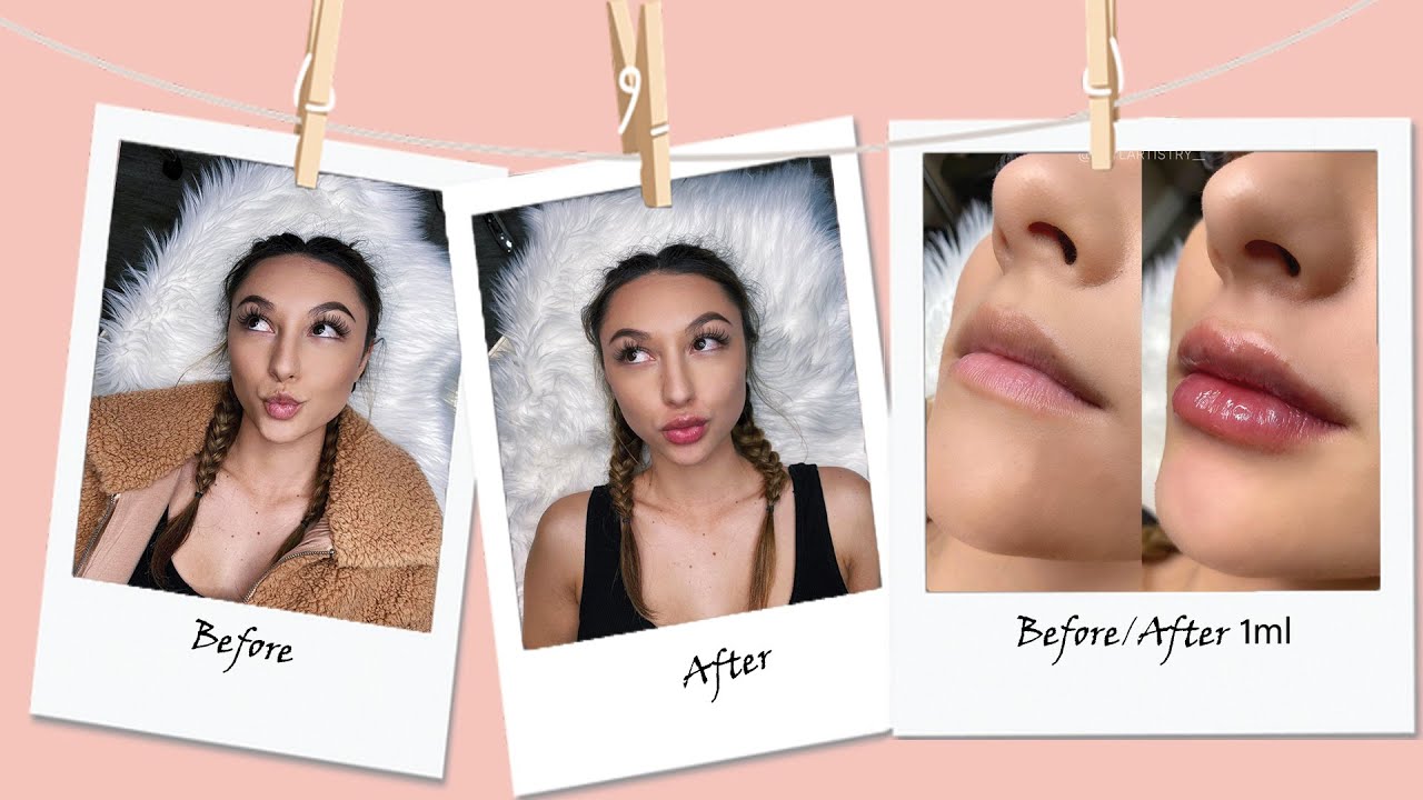GETTING MY LIPS DONE || Needle-less lip filler experience before and after