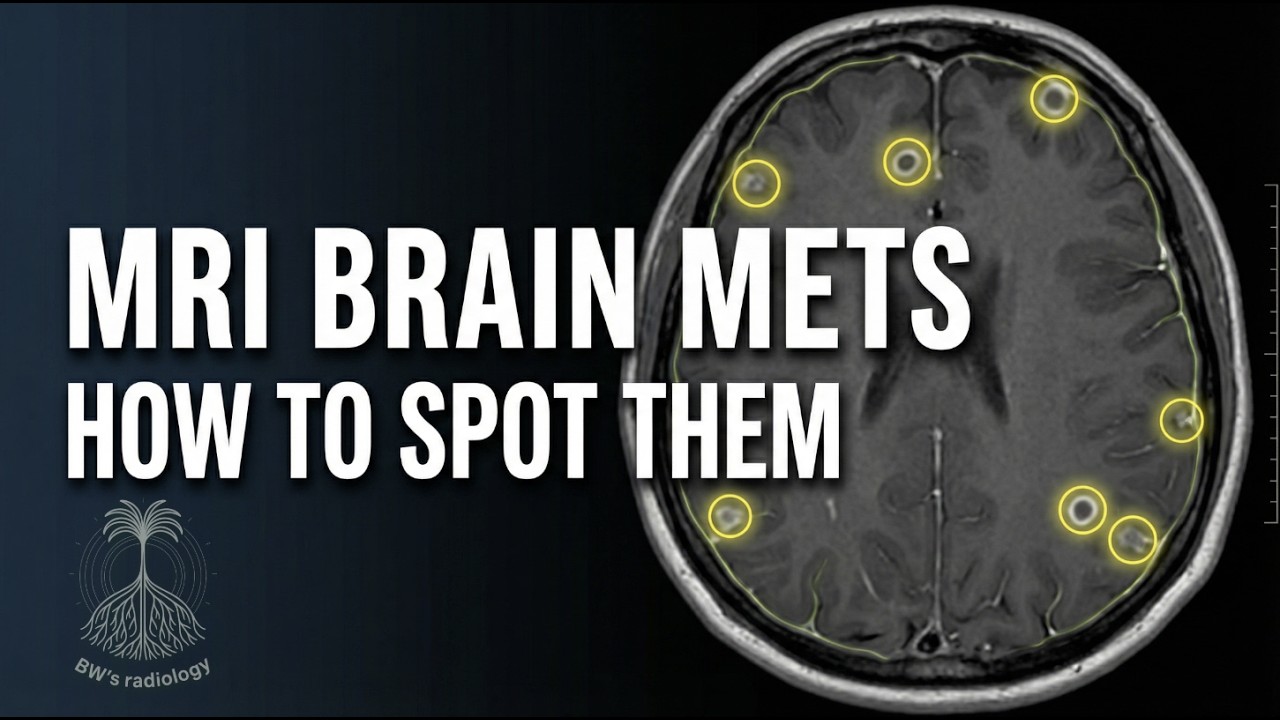 MRI Brain  - Approach to hematogeneous and leptomeningeal metastasis