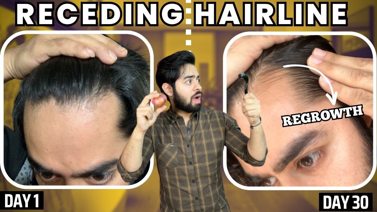 सिर्फ 1 महीने मैं RECEDING HAIRLINE REGROW करो | 30 days HAIRLINE REGROWTH challenge