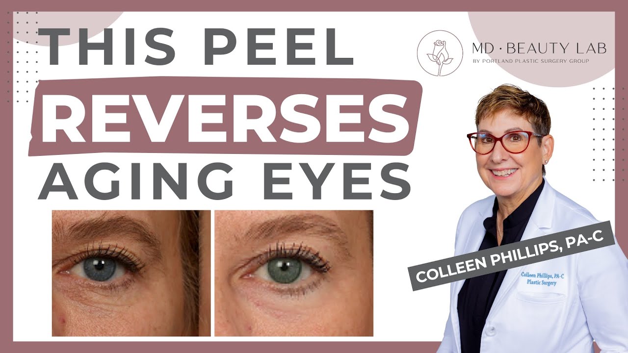 The #1 chemical peel for aging eyes, fine lines, and sun damage