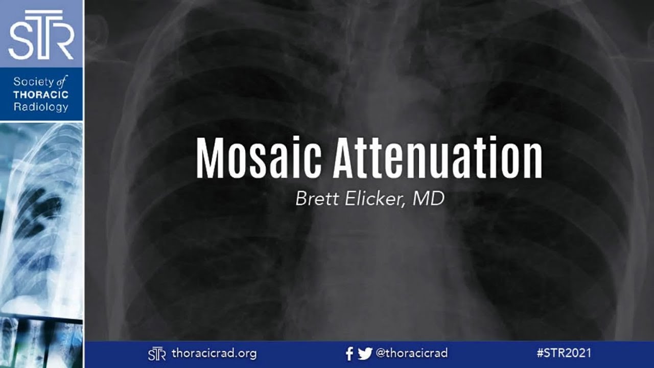 HRCT: Mosaic Attenuation