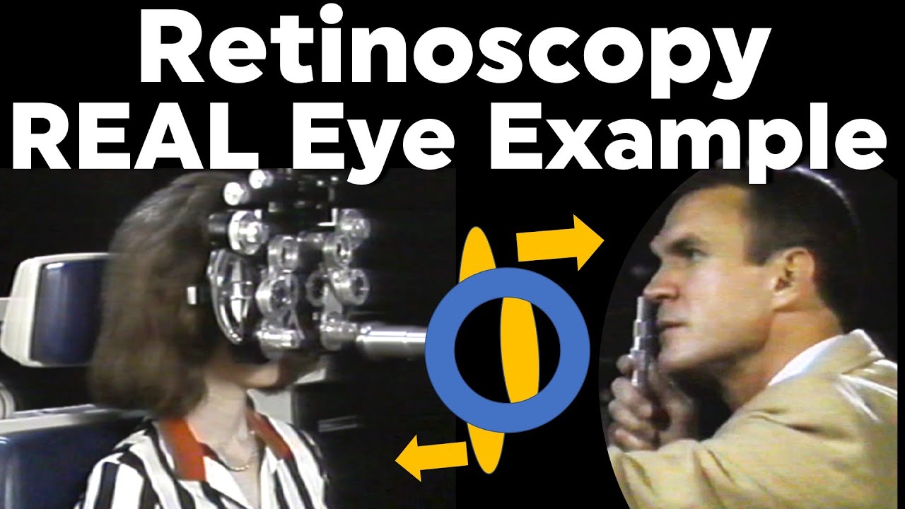 Retinoscopy Real Eye Full Example Plus Cylinder with Phoropter Refraction of the Eye