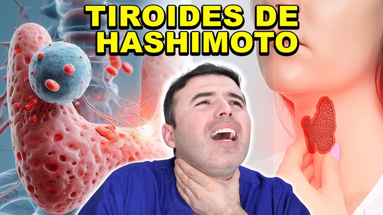 TIROIDITIS DE HASHIMOTO: EL IMPACTO DEL ESTILO DE VIDA Y EL DESORDEN METABÓLICO
