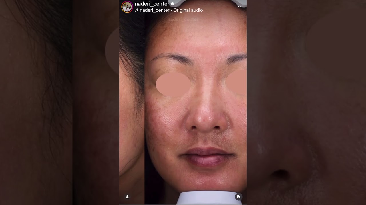 Non surgical skin tightening without the downtime ✨ #skintightening #morpheus8 #noninvasive