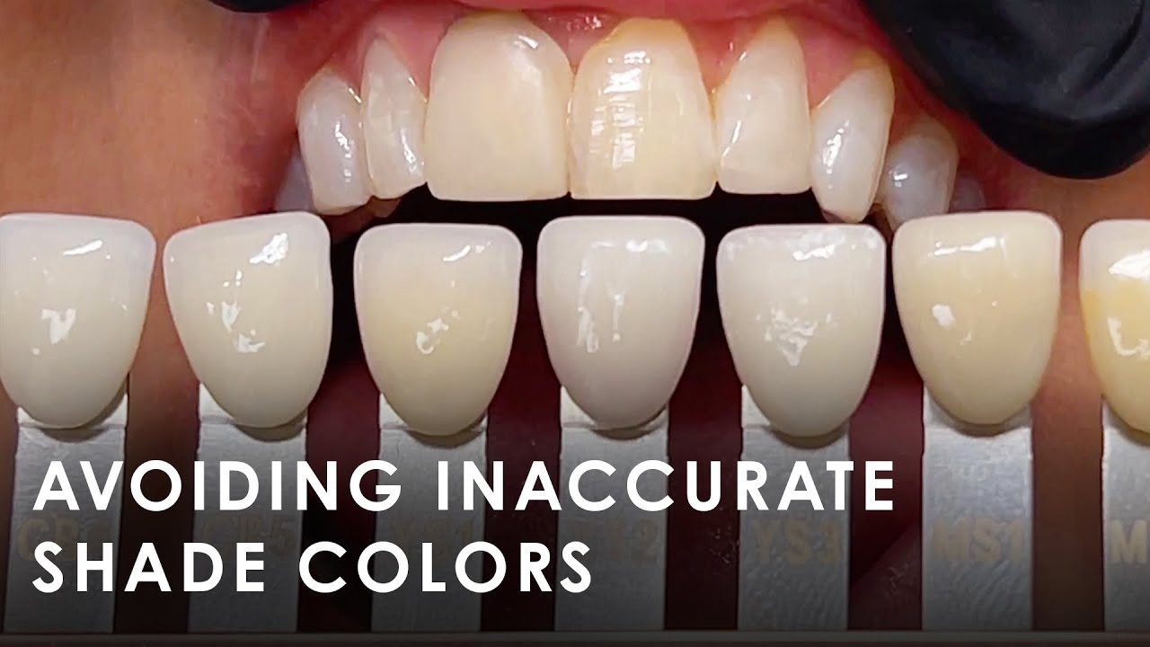 Как избежать неточных оттенков зубов