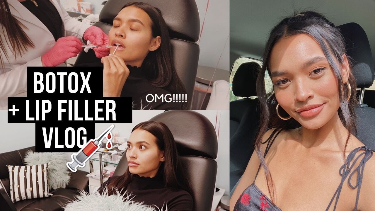 DRAMATIC LIP FILLER + BOTOX VLOG || NICOLE ELISE