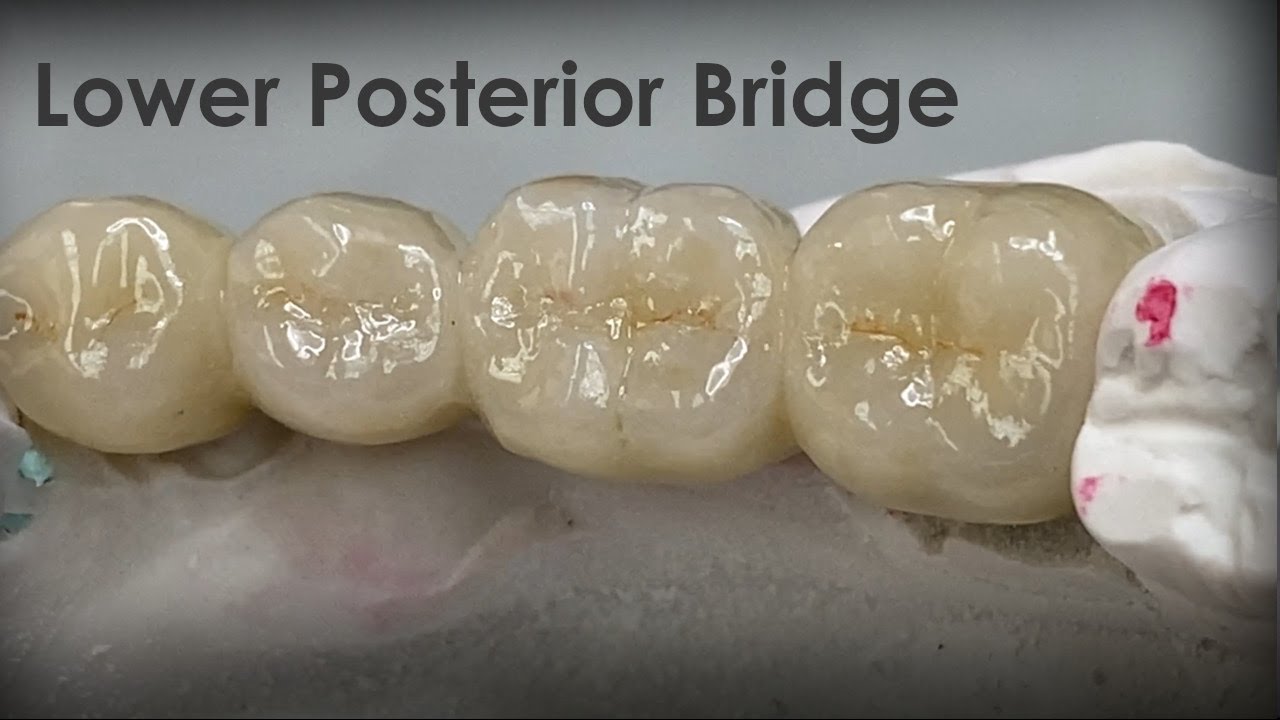 How to Make an Exceptional Lower Posterior Bridge