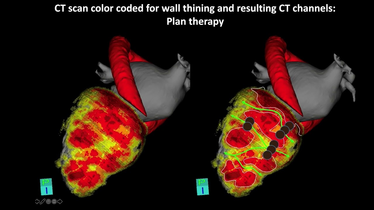 PR 2022, APRIL 24, Mapping and ablation of ventricular arrhythmias 1, Part B