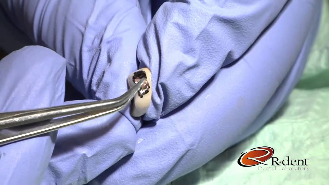How To Adjust the Bruxzir Crown
