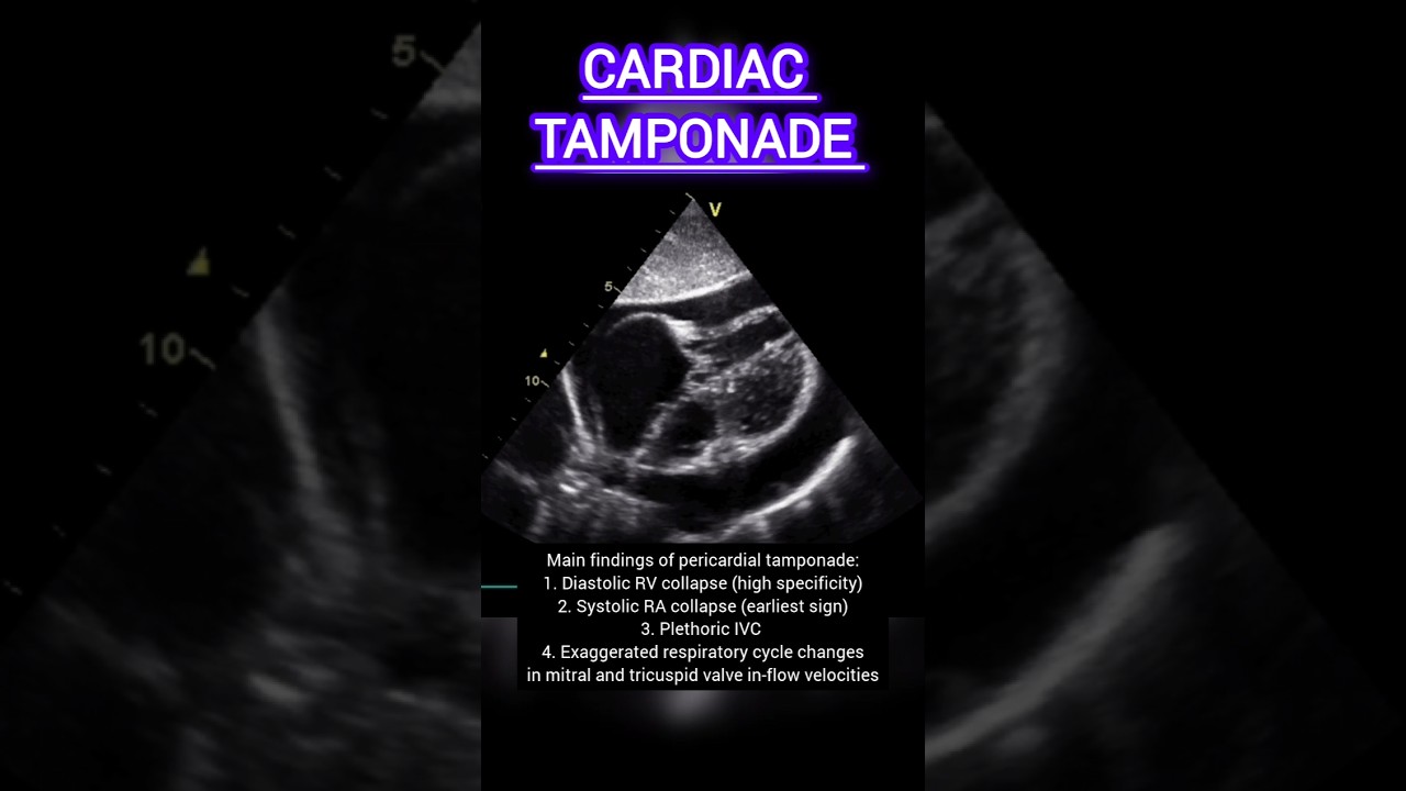 Echo Features of Pericardial Tamponade #echocardiography #heartdisease #heart #health