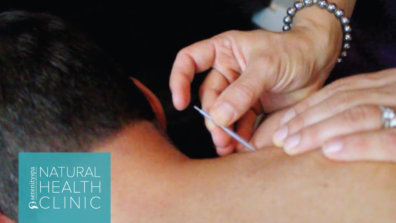 Acupuncture