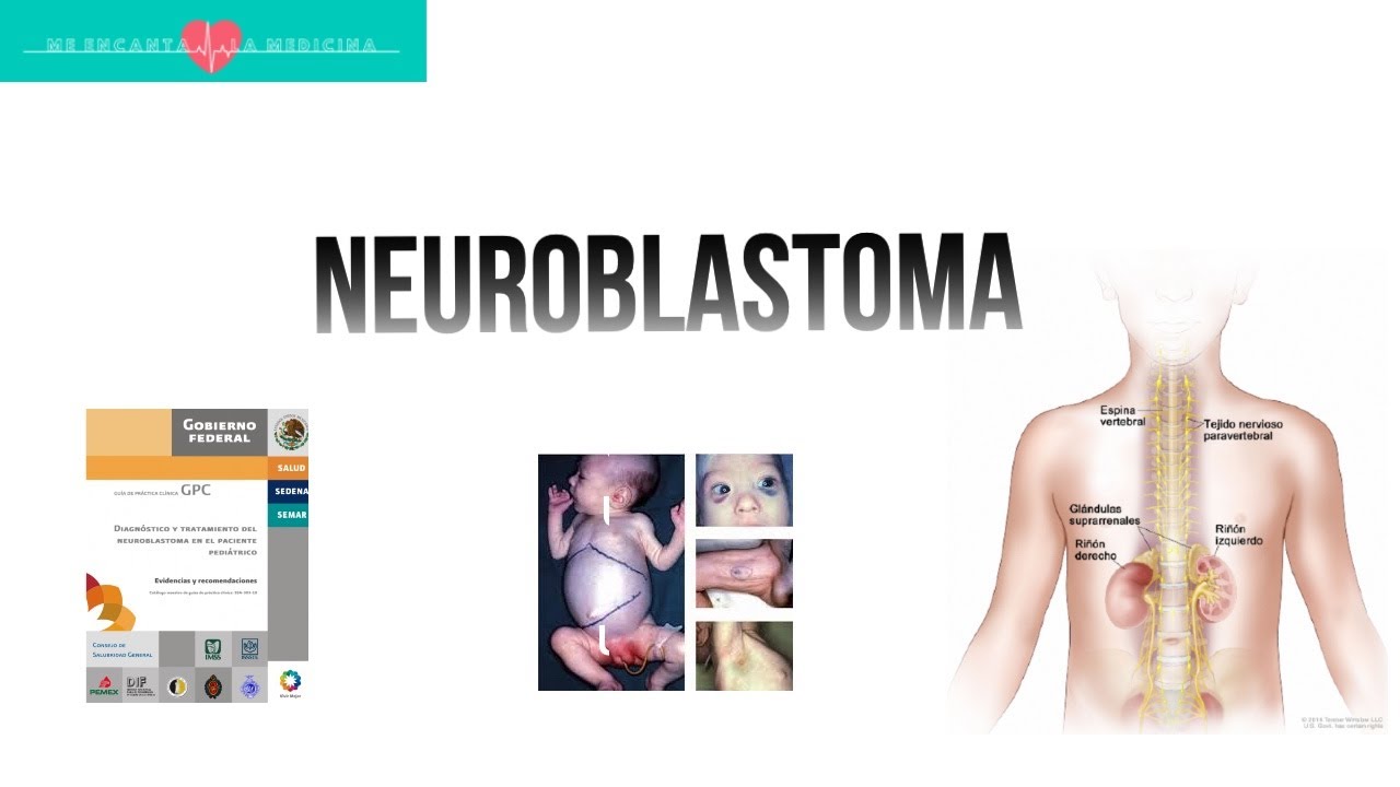 Neuroblastoma en el paciente pediátrico. ¿Qué nos dice la GPC? #ENARM
