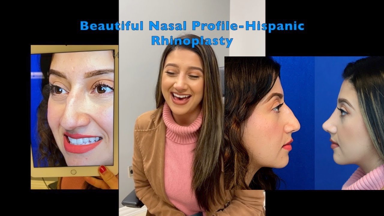 Beautiful Nasal Profile - Hispanic Rhinoplasty | Ethnic Rhinoplasty by Dr. Ali Sajjadian