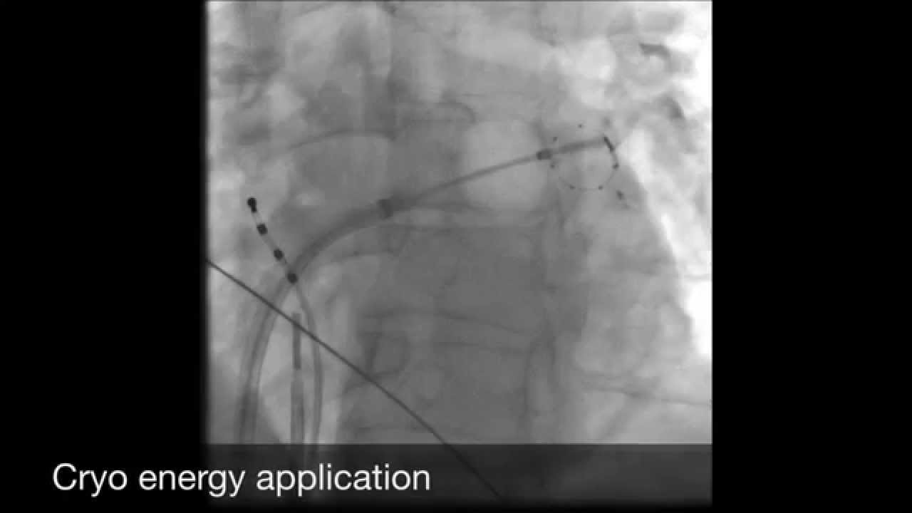 Atrial Fibrillation ablation using Cryo balloon