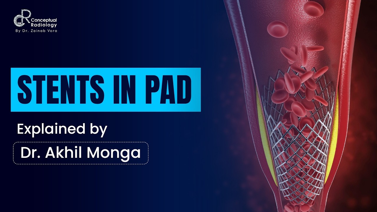 Stents in PAD Explained | Peripheral Arterial Disease | Dr. Akhil Monga