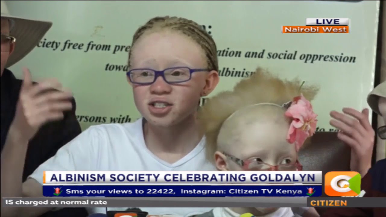 Let us celebrate Albinism- Goldalyn Kakuya Tanga