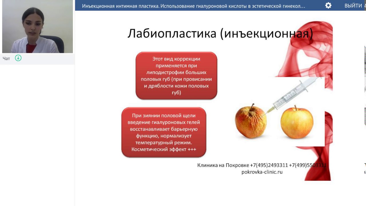 Инъекционная интимная пластика. Использование гиалуроновой кислоты в эстетической гинекологии.