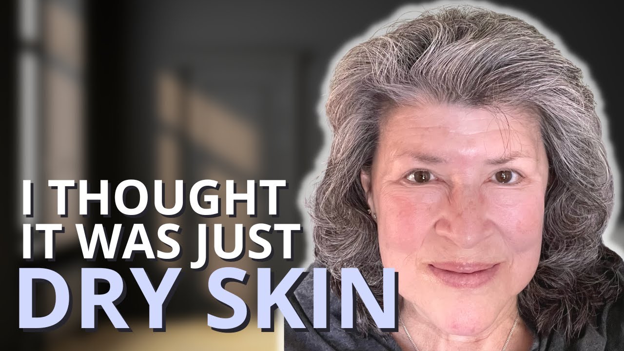 Cindy’s Stage 4 Lymphoma Symptoms: “My Skin Started To Get Really Itchy!