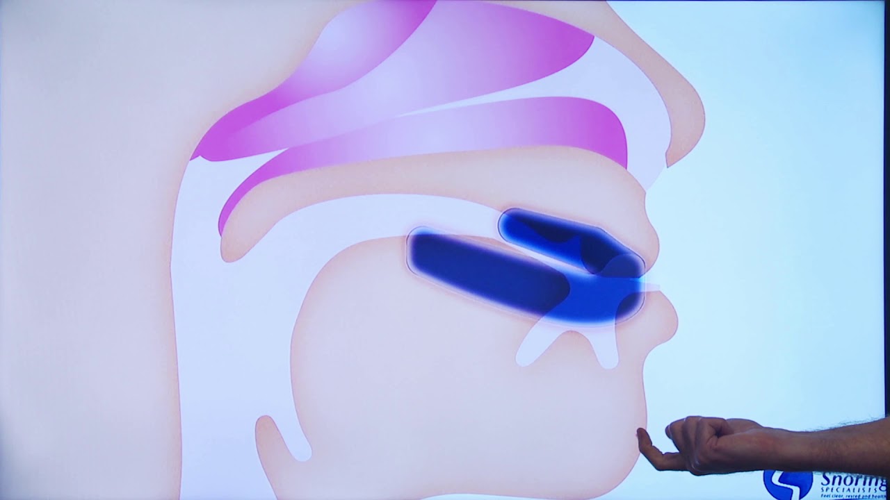 Working with Sleep Dentists to Resolve Sleep Apnea