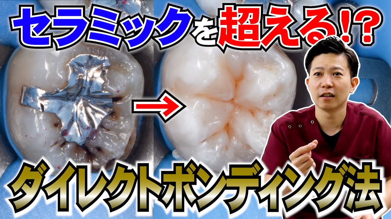この治療、もしかするとセラミックよりいいかもしれません！！