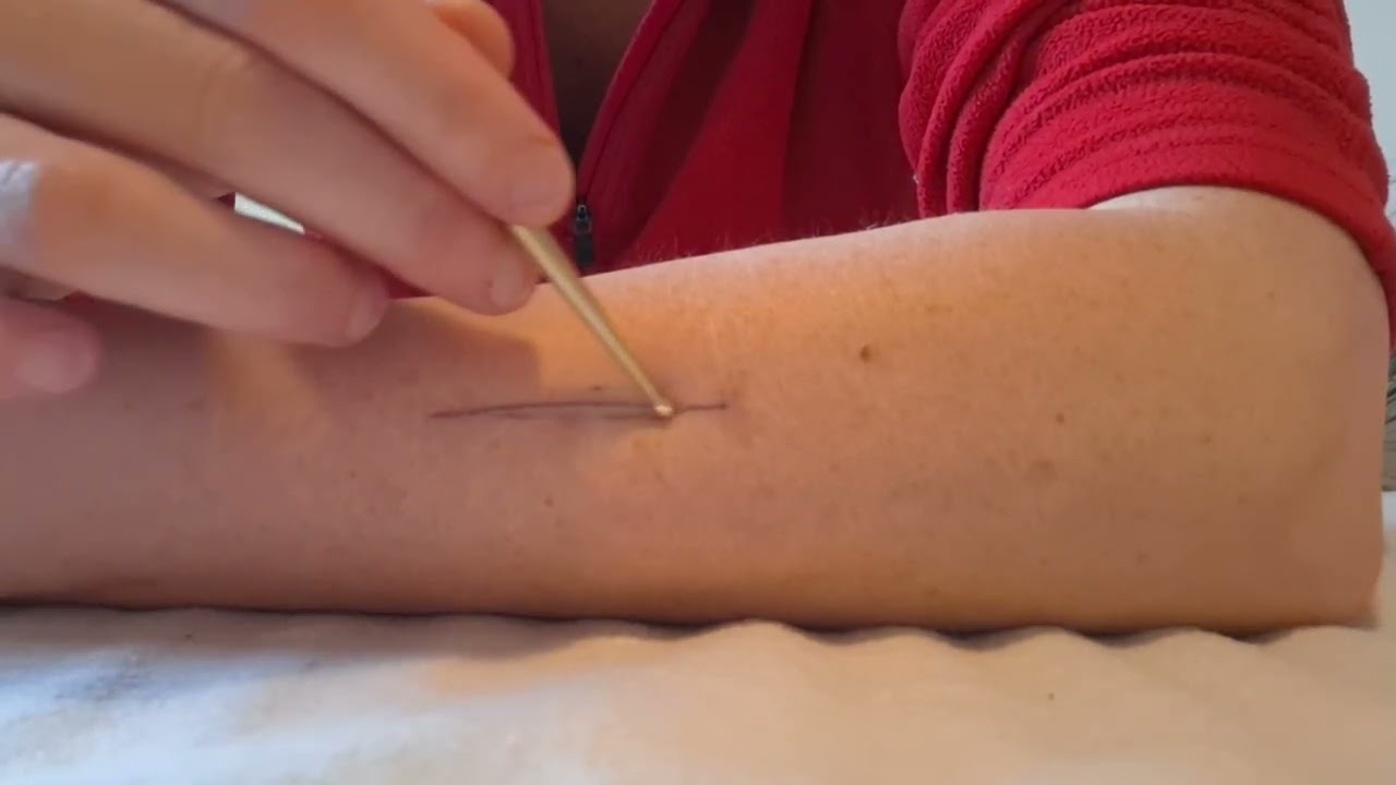 Narben mit der APM-Technik selbst behandeln