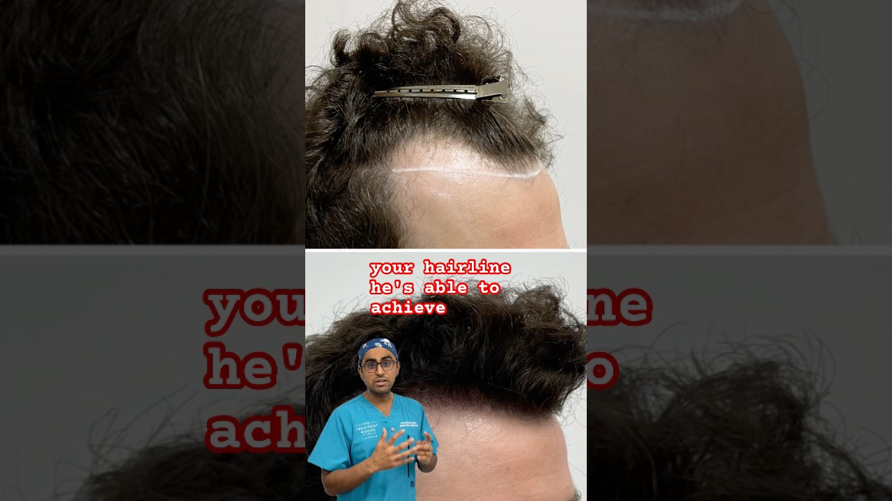 Receding hairline transplant 