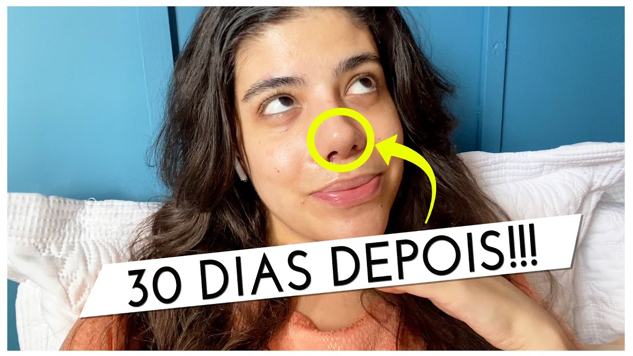 DEU TUDO ERRADO COM A MINHA RINOPLASTIA? INTERCORRÊNCIA CIRURGIA / NARIZ NEGROIDE / 30 DIAS DE PÓS