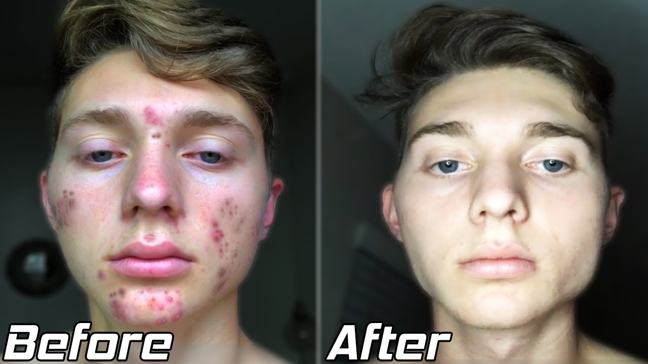 How I Cleared My Acne | Acne Transformation Story (2020)