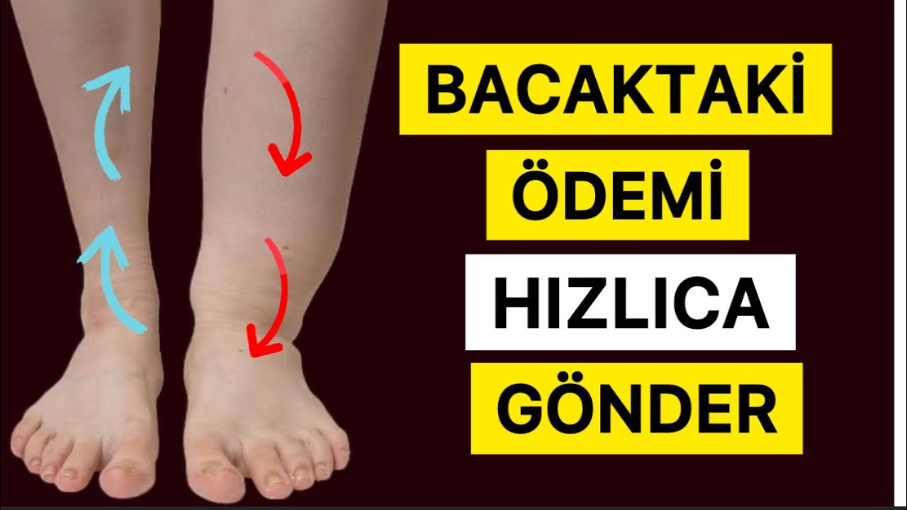 Bacaklardaki ÖDEMİ 5 Dakikada Gönderelim! #fizyoterapistmacide #ödem