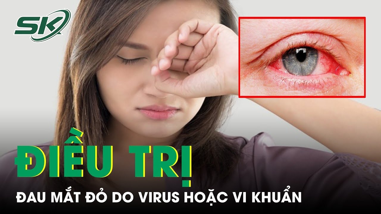 Cách Điều Trị Đau Mắt Đỏ Do Virus Hoặc Vi Khuẩn | SKĐS