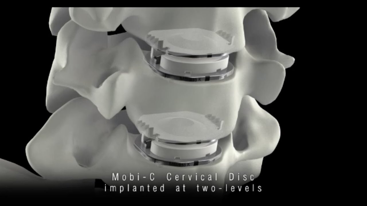 Mobi-C® Cervical Disc