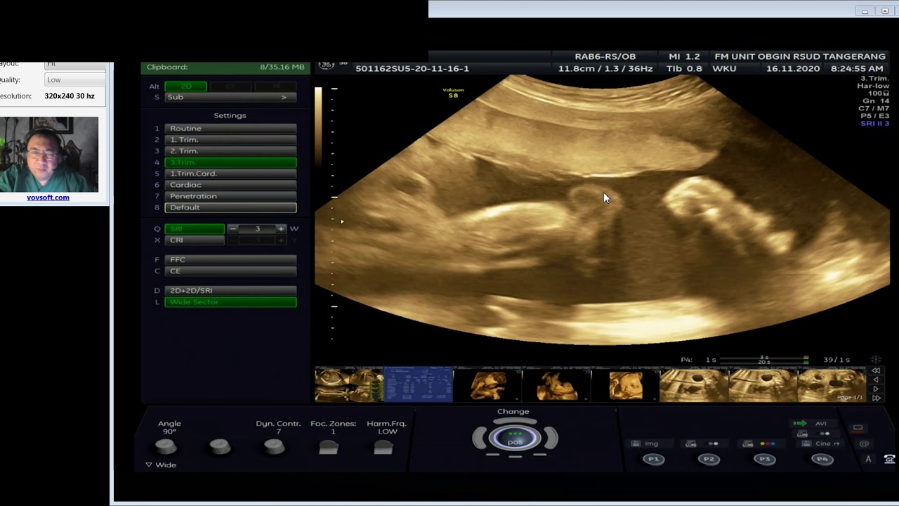 HYDRONEFROSIS GINJAL BILATERAL (Dr Wiku Andonotopo)