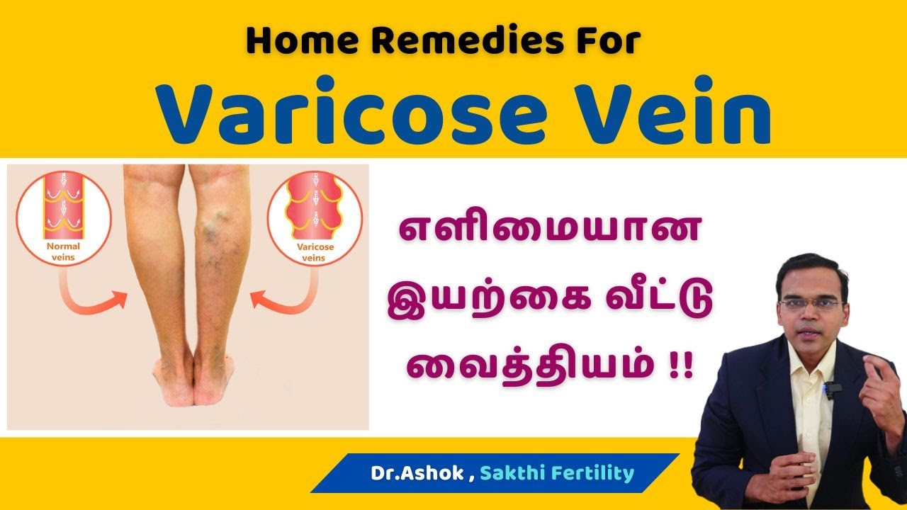 Home Remedies For Varicose Vein !! எளிமையான இயற்கை வீட்டு வைத்தியம் !! Explain With Dr. Ashok