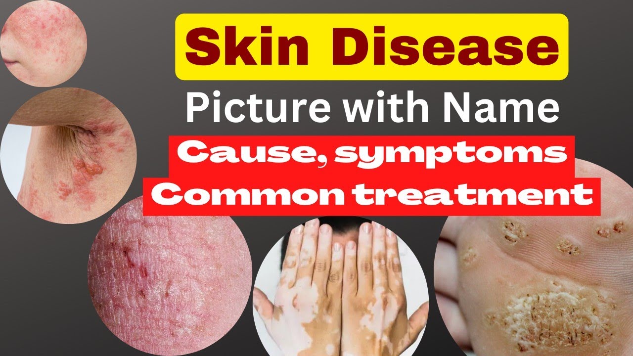skin disease picture with name | skin problem with name,cause, symptoms, common treatment, nsg.care