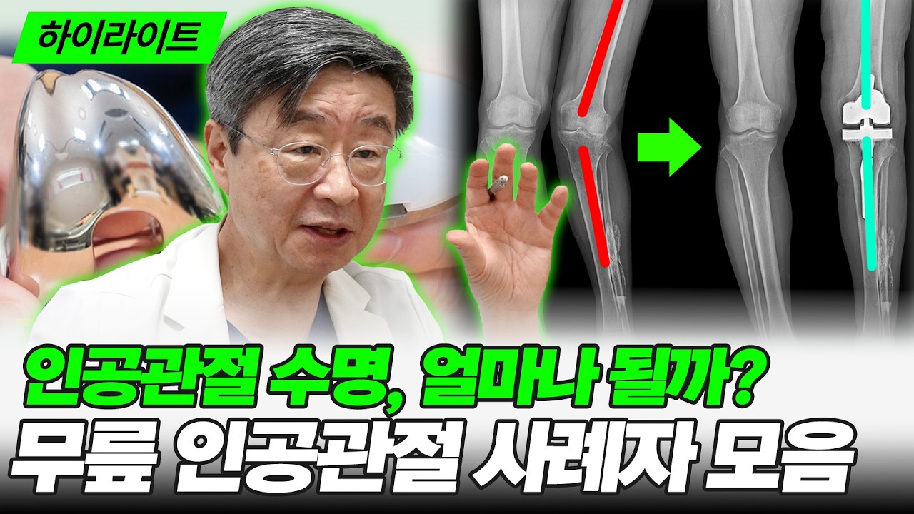 [연세사랑병원] 인공관절 수명, 얼마나 될까? 무릎 인공관절 사례자 모음!