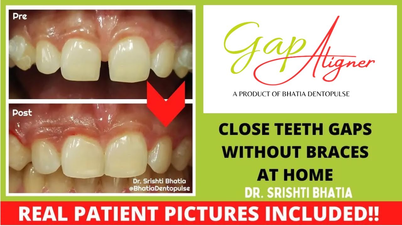 GapAligner Success Stories: Close teeth gaps at home without braces! REAL PATIENT PICTURES included