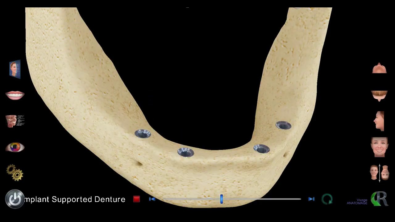 Implant Supported Denture North Massapequa, NY | Shore Smiles Dental, P.C.