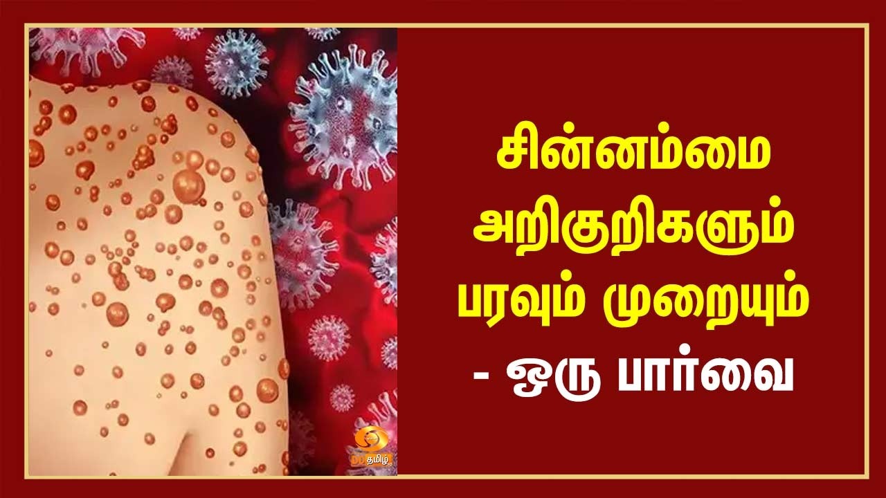 சின்னம்மை - அறிகுறிகளும் பரவும் முறையும் - ஒரு பார்வை