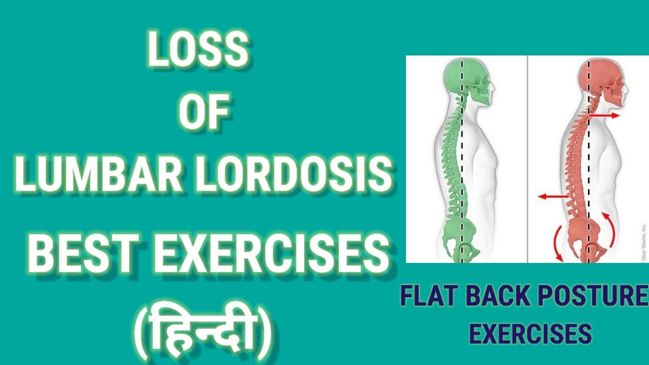Loss of Lumbar Lordosis Exercises in Hindi | Flat Back Exercises | what is loss of lumbar lordosis