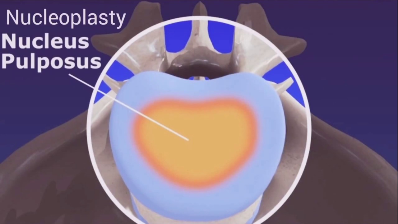 Disc Nucleoplasty