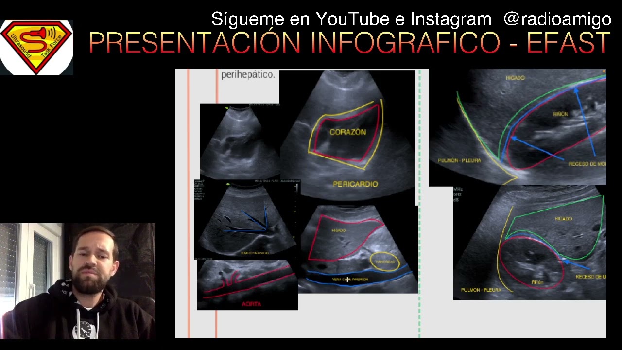 PRESENTACION INFOGRAFICO E - FAST. ULTRASONIDO ENFOCADO AL TRAUMA TORACOABDOMINAL