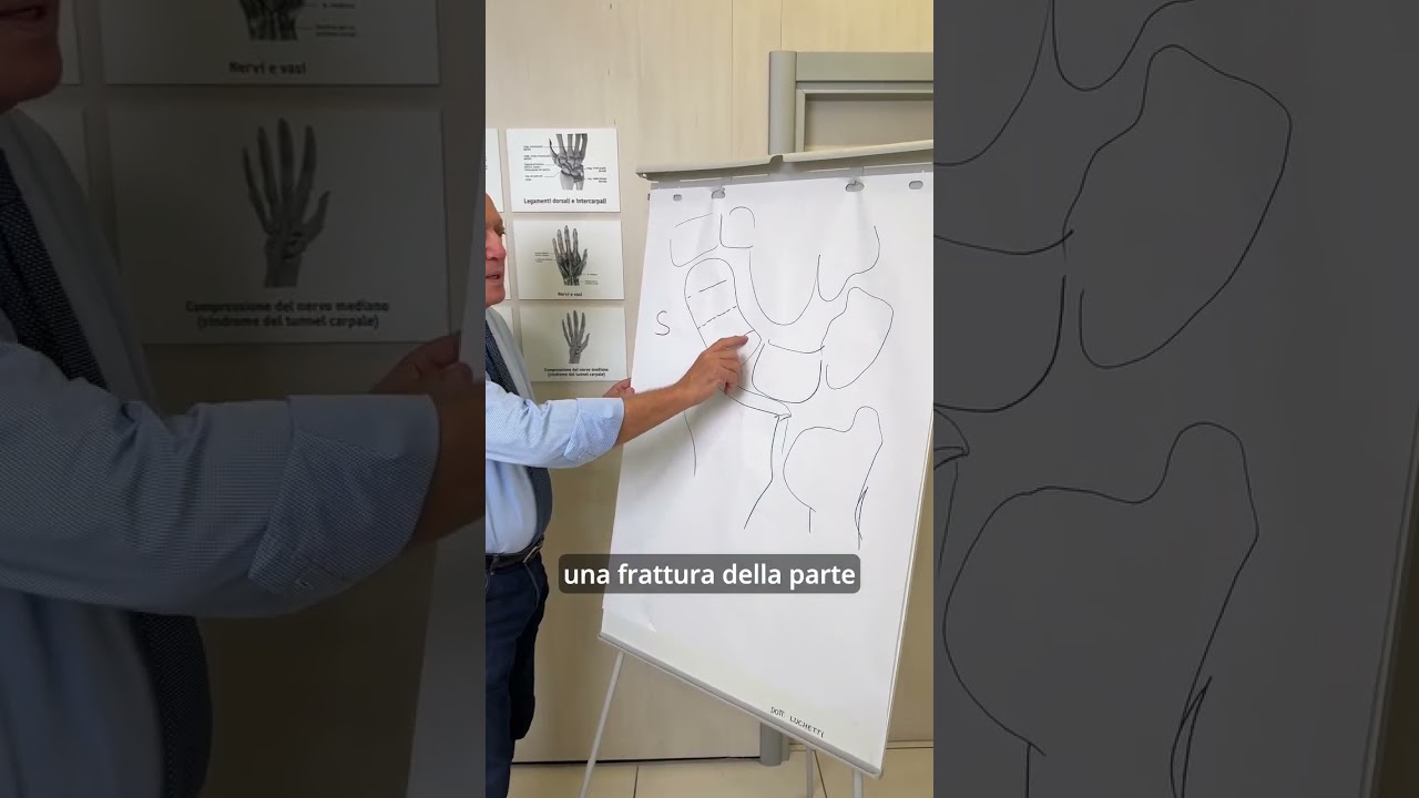 L frattura dello scafoide: cos&egrave;