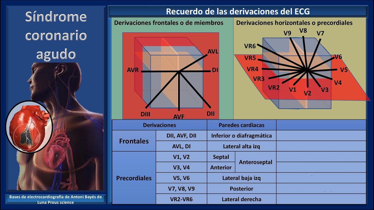 Como localizar el infarto en el electrocardiograma
