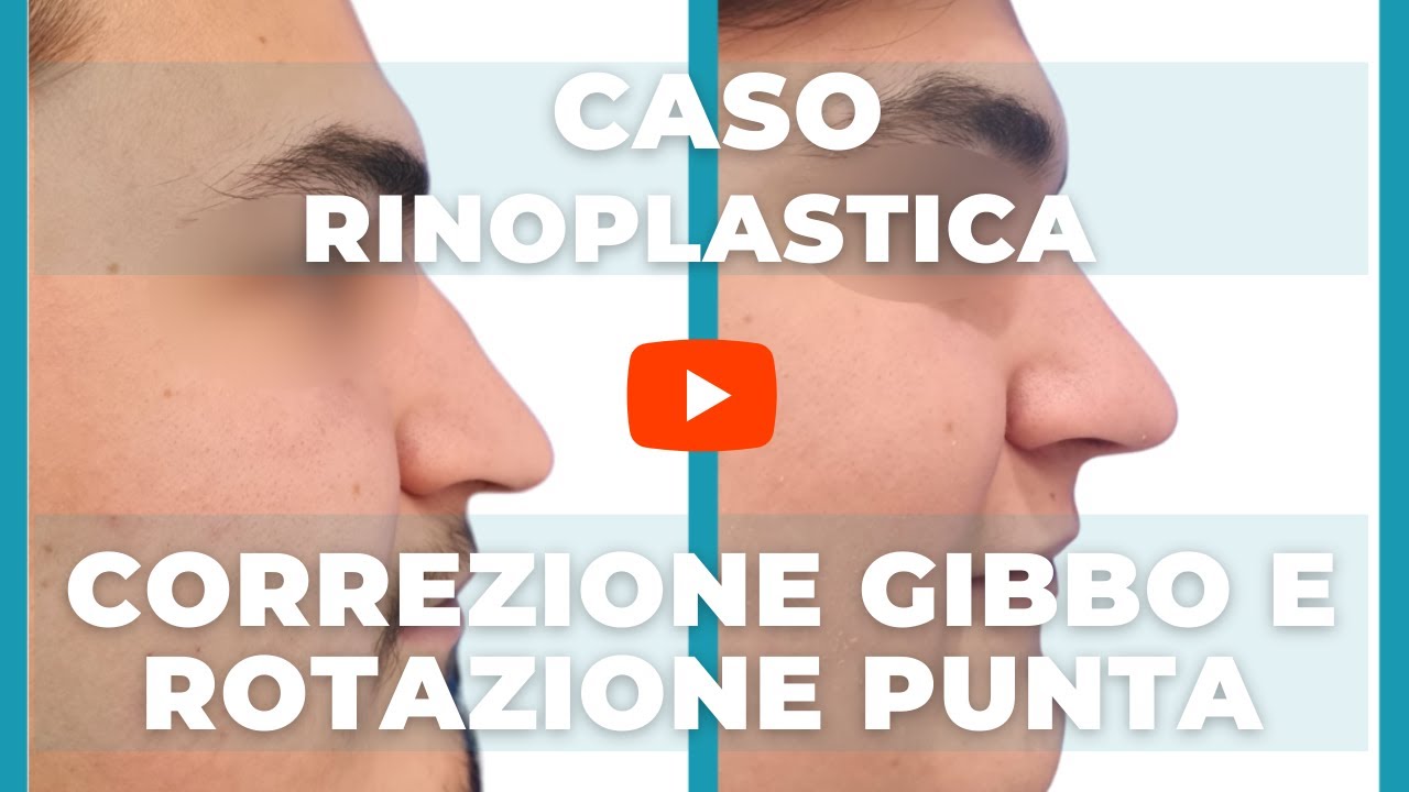 CASO DI RINOPLASTICA su naso con problemi estetici e respiratori