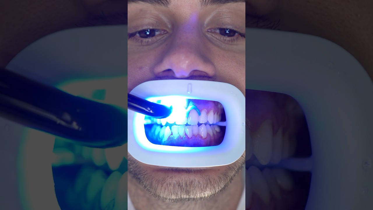 Transformation of Yellow Teeth! #teethwhitening